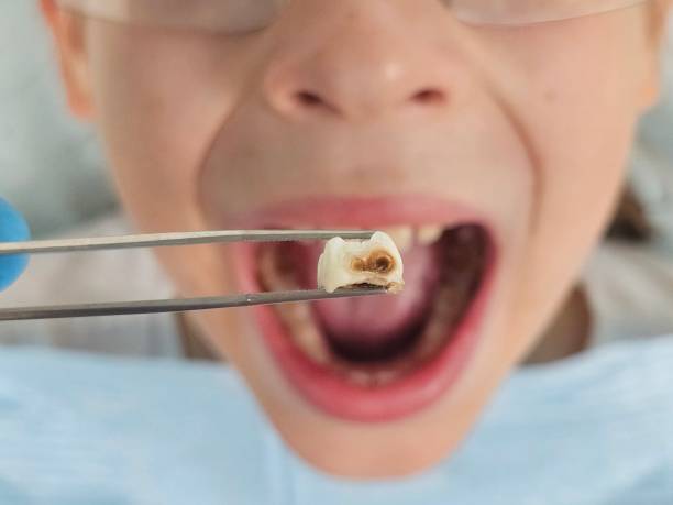 Best Emergency Tooth Extraction in Baraga, MI